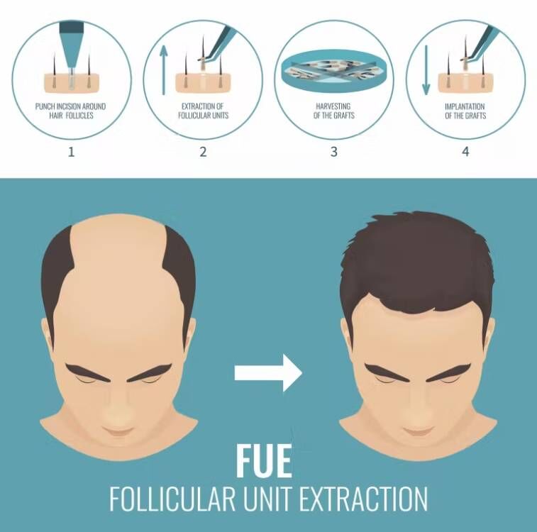 FUE Hair Implant Micro Motor H - đánh giá và giá Hair Care Vegan